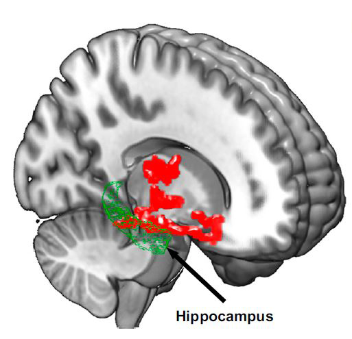 caption: Brain imaging after one night of sleep deprivation revealed beta-amyloid accumulation in the hippocampus and thalamus, regions affected by Alzheimer’s disease; Credit: Proceedings of the National Academy of Sciences
